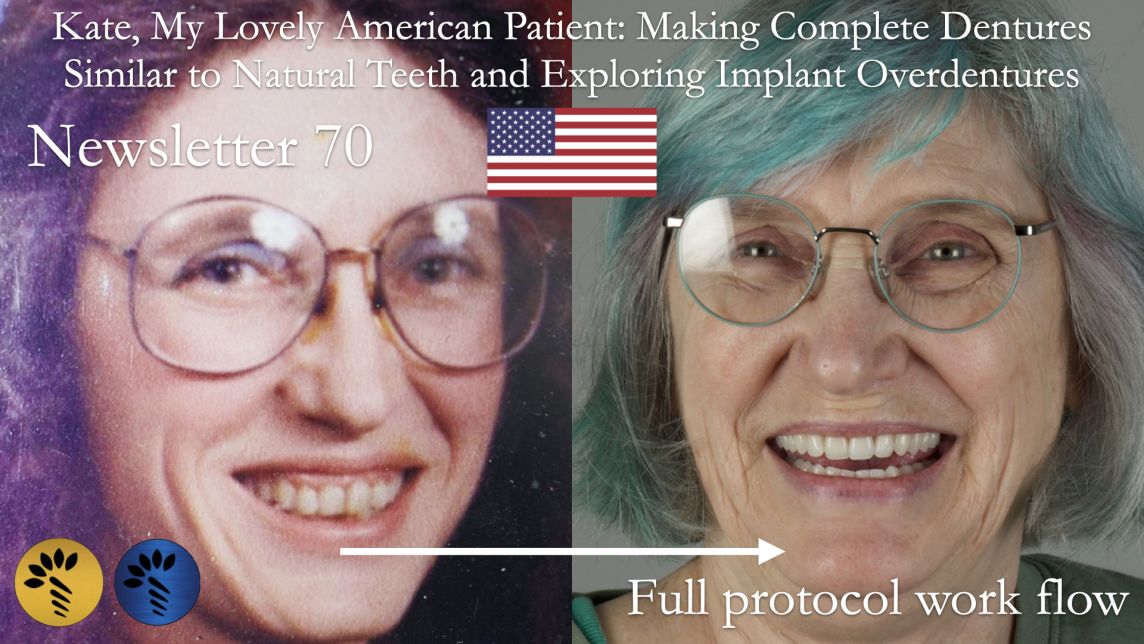 Complete Denture Course: Hands-on Learning with Real-Life Insights from Kate, Our US Demo Patient