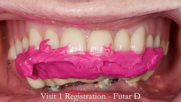 Newsletter 49 Managing Estelle’s failing implants with dentures FULL PROTOCOL