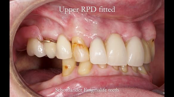 Managing Edgar “THE SCEPTIC” with an RPD/Splint FULL CASE