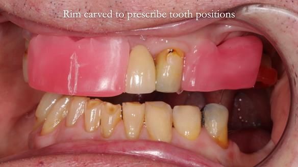 Managing Edgar “THE SCEPTIC” with an RPD/Splint FULL CASE