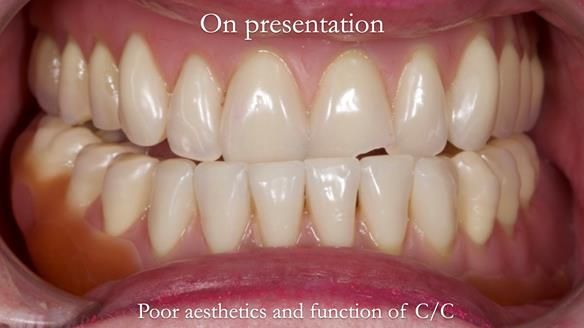 Replacing Madeline’s Complete denture FULL PROTOCOL