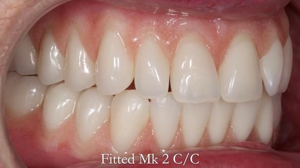 Replacing Madeline’s Complete denture FULL PROTOCOL