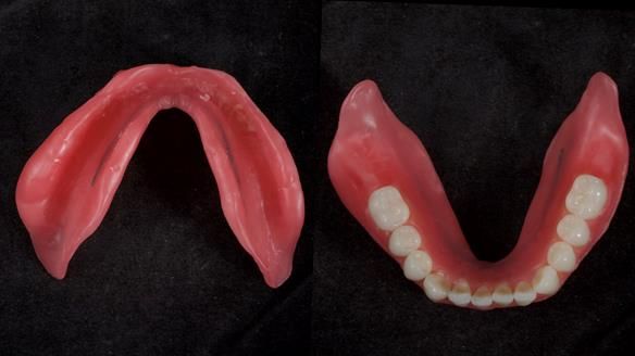 Newsletter 70 Complete Denture Treatment for Kate: A Case Study on Natural-Looking Dentures and Implant-Supported Overdentures