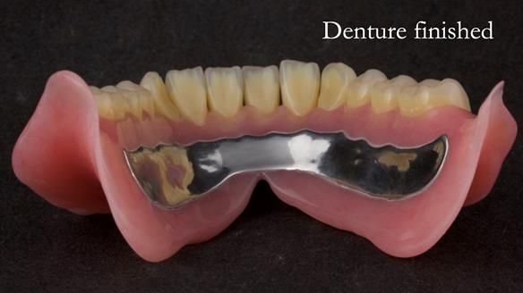 Newsletter 74: Ken’s Case Study Complete Dentures - Life Like and Age Appropriate