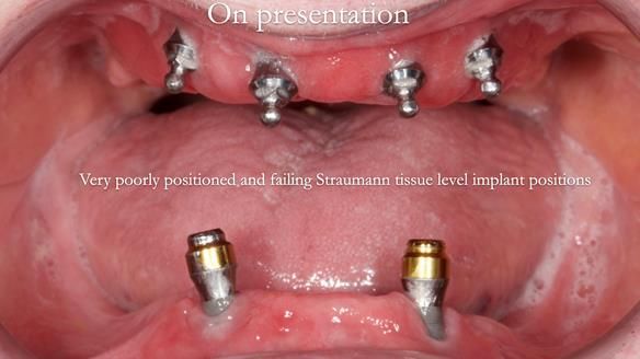 Newsletter 65 Marisa Provision of Complete Dentures on badly placed implants