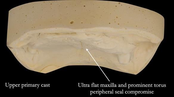 Solving Linda’s Failed “All on 4” implant bridges - full protocol Newsletter 42