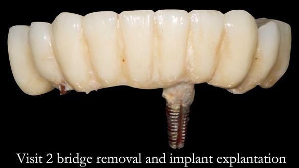 Newsletter 49 Managing Estelle’s failing implants with dentures FULL PROTOCOL