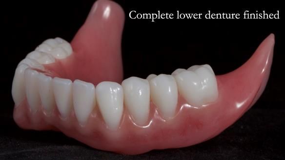 Newsletter 65 Marisa Provision of Complete Dentures on badly placed implants