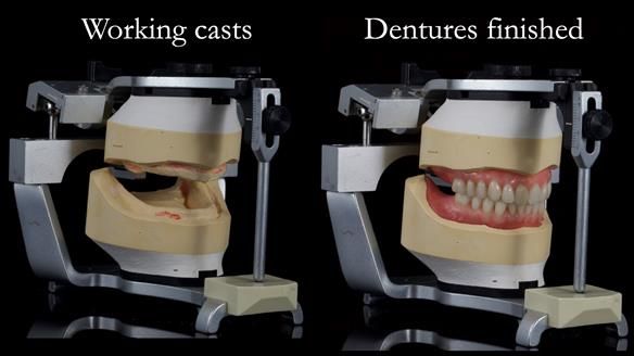 Newsletter 70 Complete Denture Treatment for Kate: A Case Study on Natural-Looking Dentures and Implant-Supported Overdentures