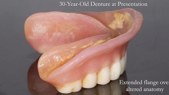 Newsletter 68 Restoring Jan’s Smile: Complete Dentures Inspired by Her Daughter’s Teeth - Post Mouth Surgery