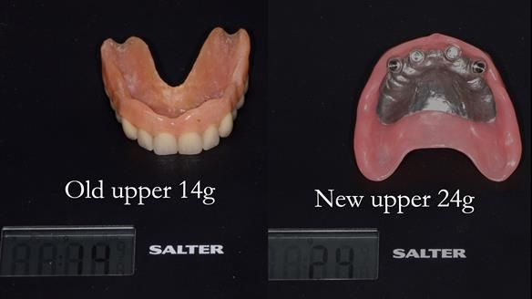 Newsletter 65 Marisa Provision of Complete Dentures on badly placed implants