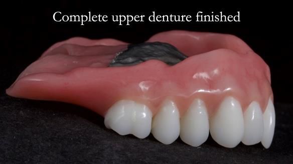 Newsletter 65 Marisa Provision of Complete Dentures on badly placed implants