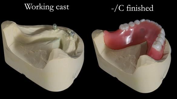 Newsletter 65 Marisa Provision of Complete Dentures on badly placed implants