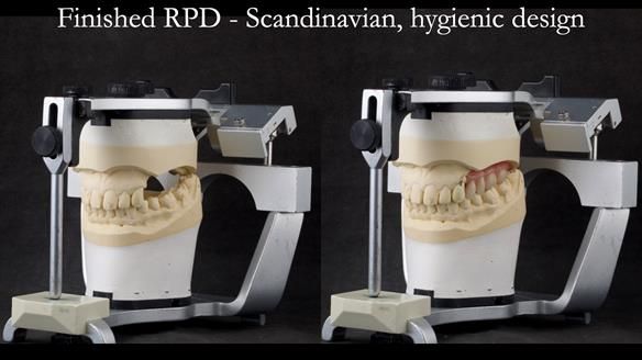 Newsletter 44 - extreme removable prosthodontics – engineering a super-strong and ultra-thin over denture