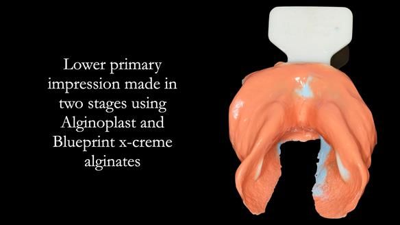 Replacing Madeline’s Complete denture FULL PROTOCOL