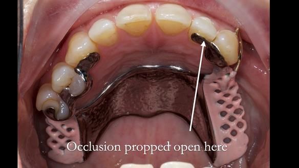 Solving Sue's failed implants with metal based RPD - full protocol Newsletter 43