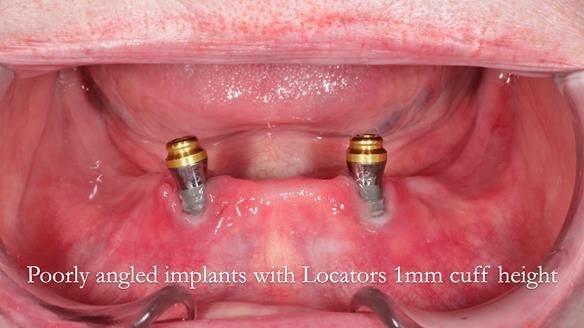 Newsletter 65 Marisa Provision of Complete Dentures on badly placed implants