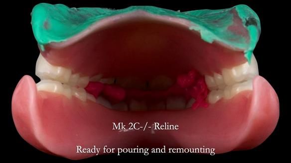 Replacing Madeline’s Complete denture FULL PROTOCOL