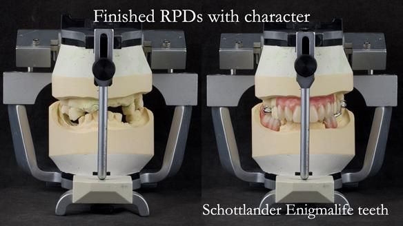 Eileen's transformation with upper and lower RPDs of Scandinavian hygienic design FULL PROTOCOL