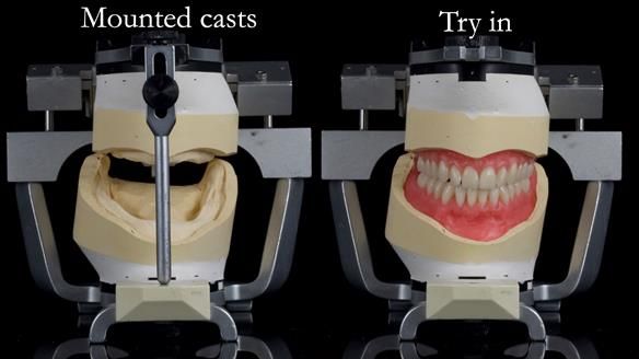 Newsletter 68 Restoring Jan’s Smile: Complete Dentures Inspired by Her Daughter’s Teeth - Post Mouth Surgery