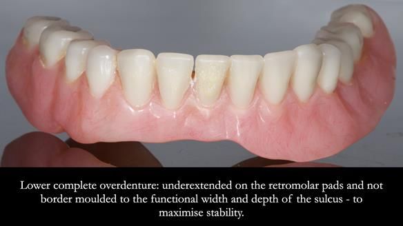 Newsletter 74: Ken’s Case Study Complete Dentures - Life Like and Age Appropriate