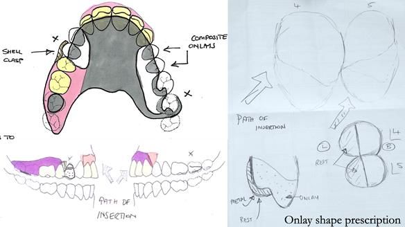 How Keith’s combat denture transformed his life – Newsletter 73