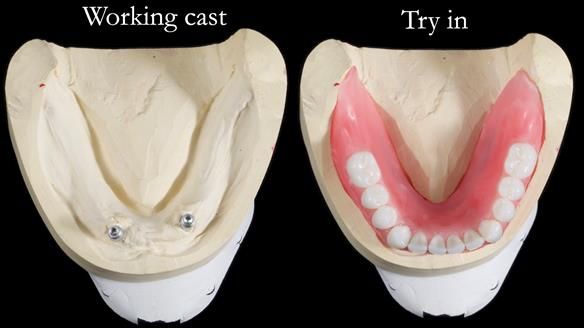 Newsletter 65 Marisa Provision of Complete Dentures on badly placed implants