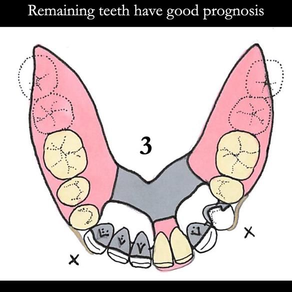 Universal Scandinavian partial denture designs