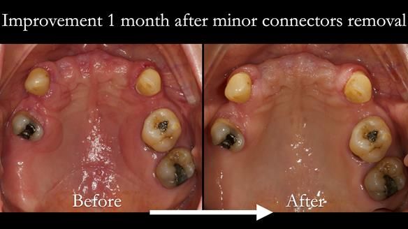 Newsletter 71 Jean’s Class I Mod III RPD: See my mistakes Fractured Mk1 to a Stronger Mk2 RPD (4 years on)