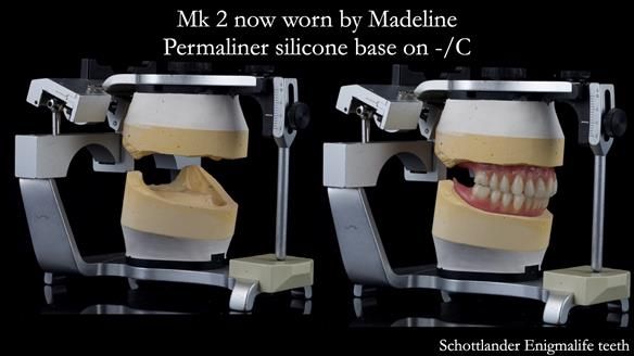 Replacing Madeline’s Complete denture FULL PROTOCOL