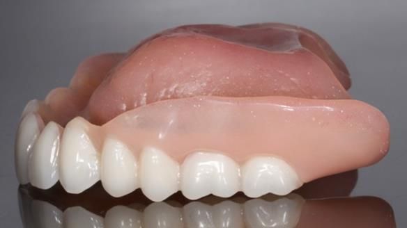 Newsletter 70 Complete Denture Treatment for Kate: A Case Study on Natural-Looking Dentures and Implant-Supported Overdentures