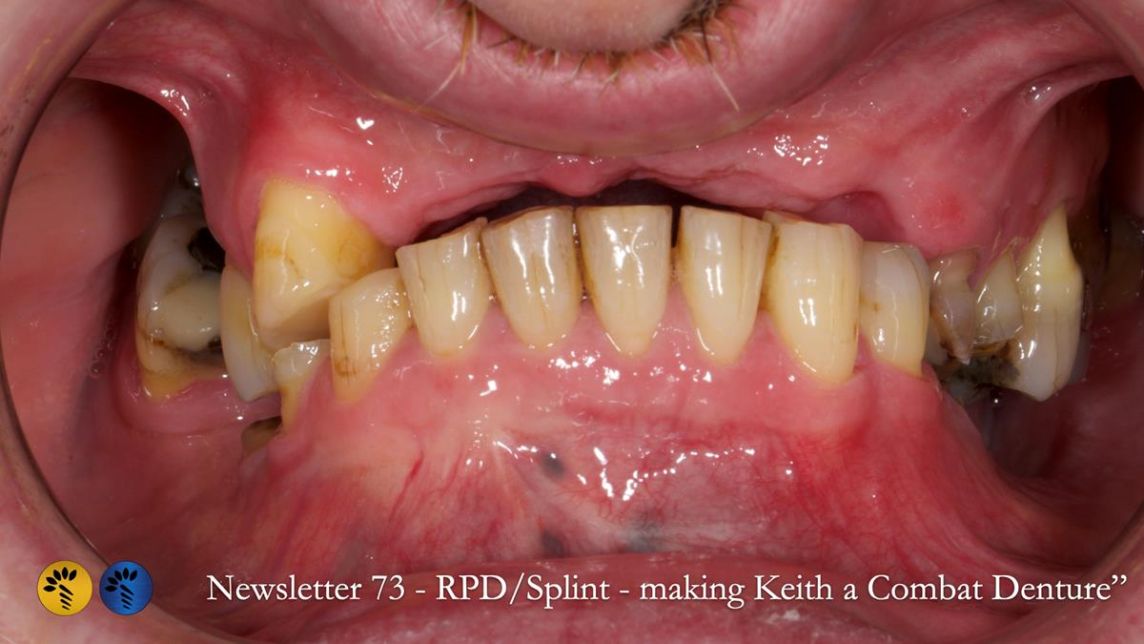 How Keith’s combat denture transformed his life – Newsletter 73