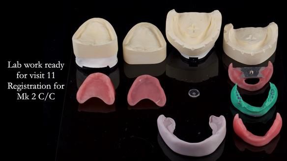 Replacing Madeline’s Complete denture FULL PROTOCOL