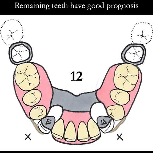 Universal Scandinavian partial denture designs