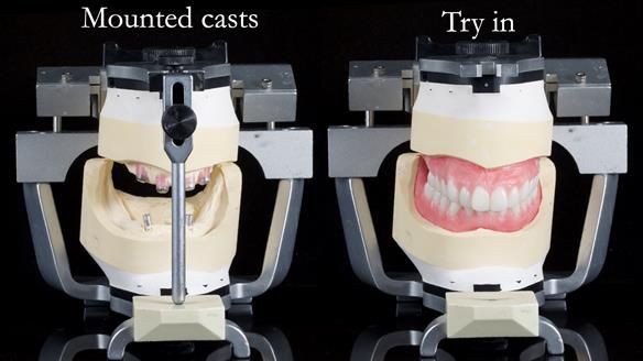 Newsletter 65 Marisa Provision of Complete Dentures on badly placed implants