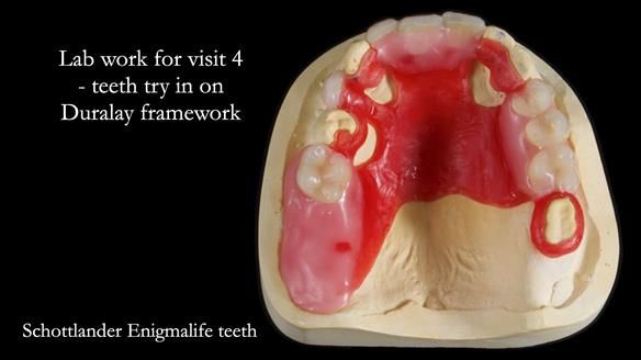 Managing Edgar “THE SCEPTIC” with an RPD/Splint FULL CASE