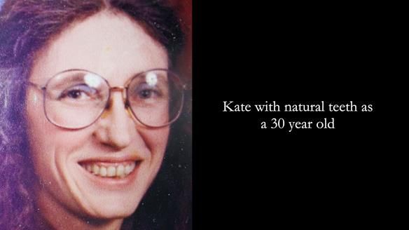 Newsletter 70 Complete Denture Treatment for Kate: A Case Study on Natural-Looking Dentures and Implant-Supported Overdentures