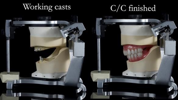 Newsletter 65 Marisa Provision of Complete Dentures on badly placed implants