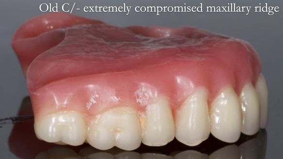 Solving Linda’s Failed “All on 4” implant bridges - full protocol Newsletter 42