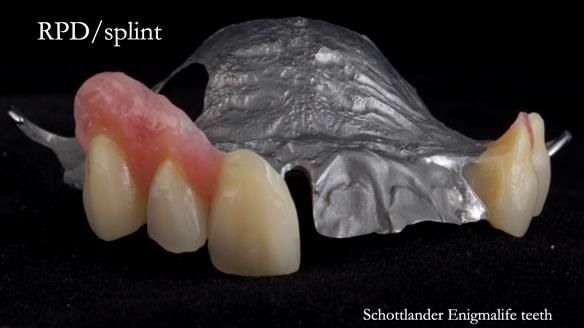 Read Newsletter 67 - Brian's COMBAT DENTURE Case Study