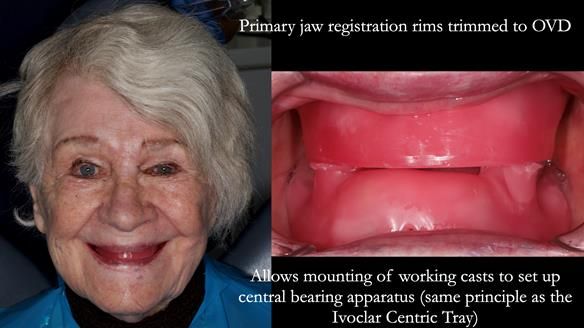 Newsletter 65 Marisa Provision of Complete Dentures on badly placed implants