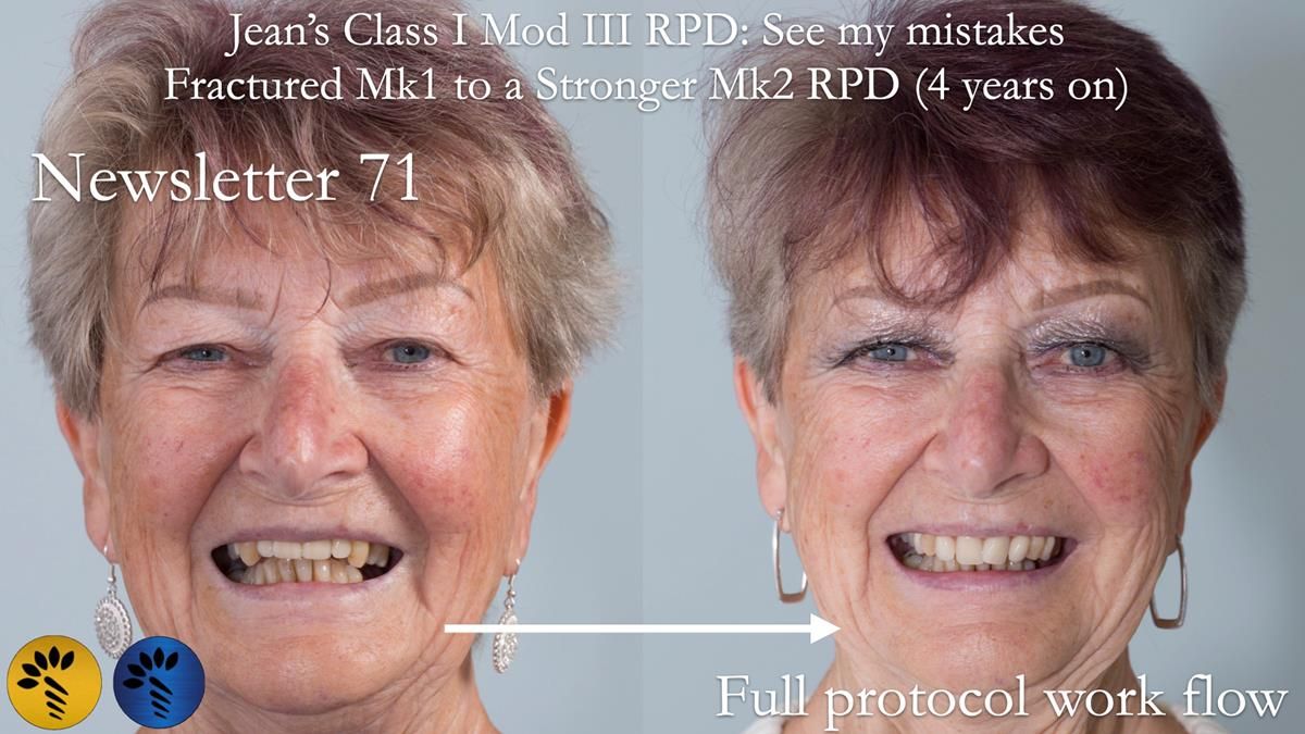 Newsletter 71 Jean’s Class I Mod III RPD: See my mistakes Fractured Mk1 to a Stronger Mk2 RPD (4 years on)