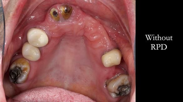 Eileen's transformation with upper and lower RPDs of Scandinavian hygienic design FULL PROTOCOL