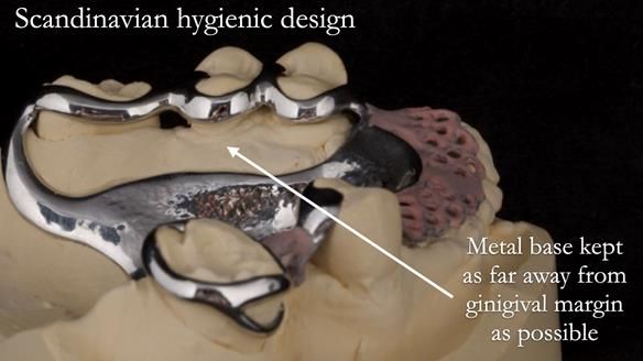 Eileen's transformation with upper and lower RPDs of Scandinavian hygienic design FULL PROTOCOL