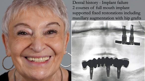 Newsletter 49 Managing Estelle’s failing implants with dentures FULL PROTOCOL