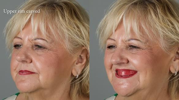 Newsletter 68 Restoring Jan’s Smile: Complete Dentures Inspired by Her Daughter’s Teeth - Post Mouth Surgery