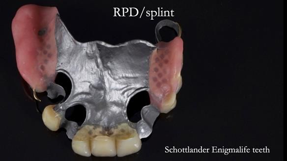 Managing Edgar “THE SCEPTIC” with an RPD/Splint FULL CASE