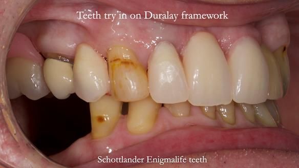 Managing Edgar “THE SCEPTIC” with an RPD/Splint FULL CASE