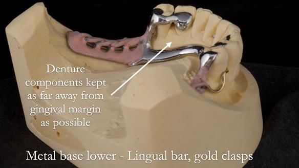 Solving Linda’s Failed “All on 4” implant bridges - full protocol Newsletter 42