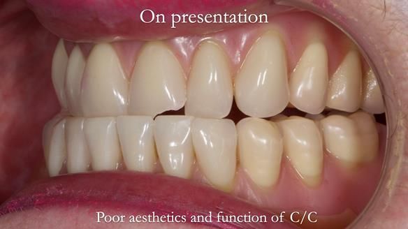 Replacing Madeline’s Complete denture FULL PROTOCOL